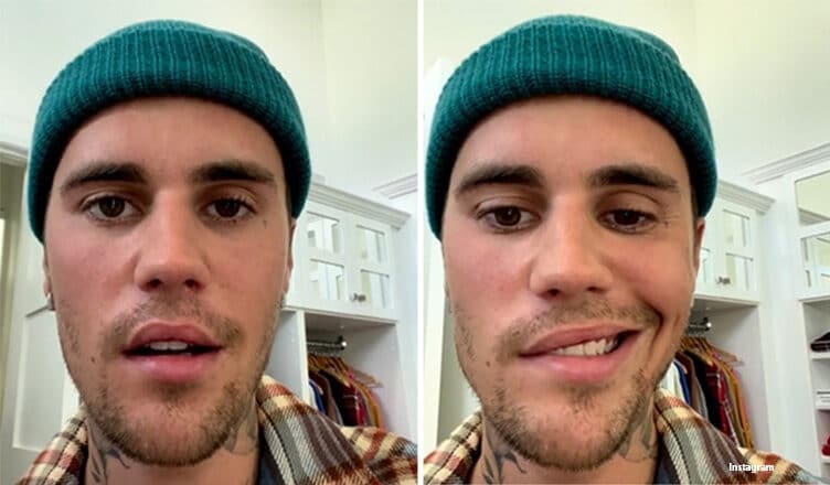 Justin Bieber says he has facial paralysis (Credit: Instagram)